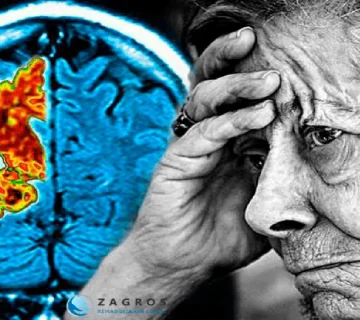 آلزایمر ، درمان آلزایمر ، بیماری آلزایمر ، عوارض آزایمر ، پیشگیری از آلزایمر