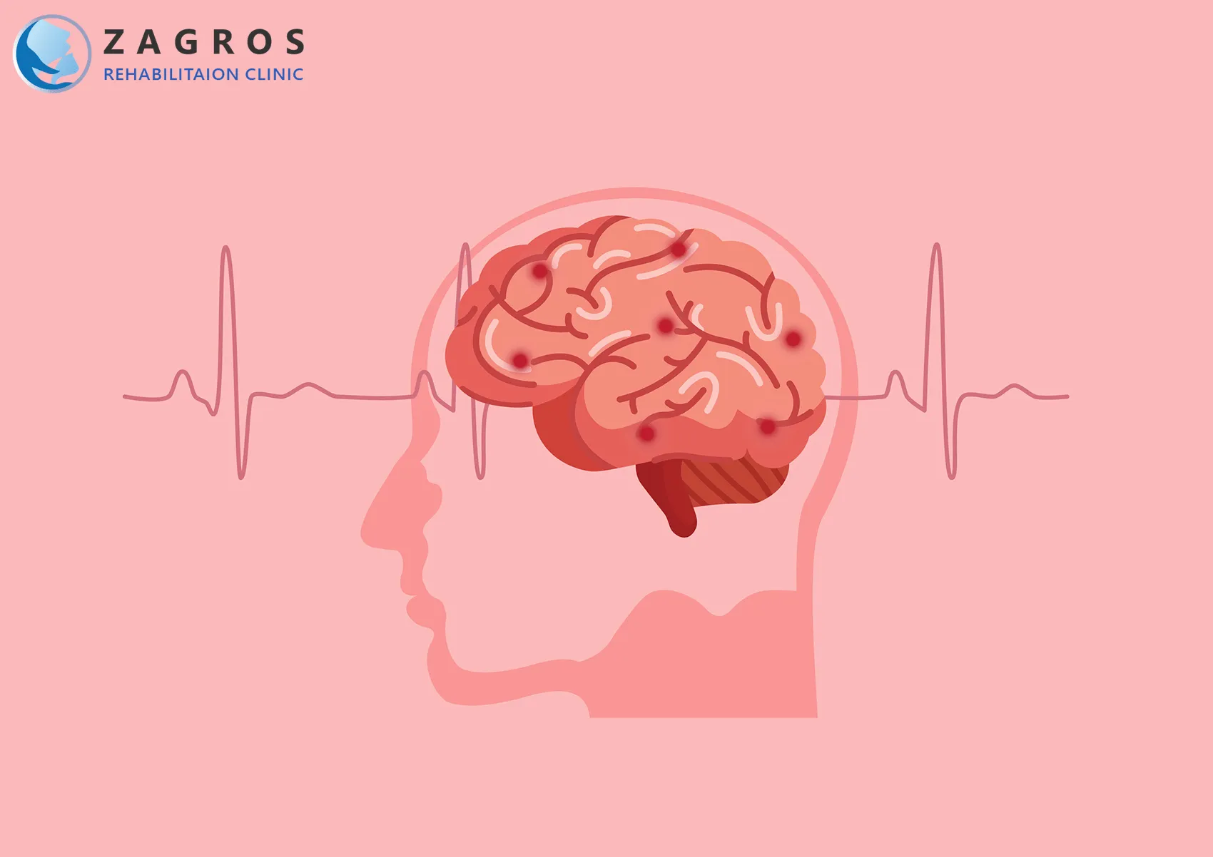 سکته مغزی ، درمان سکته مغزی ، علائم سکته مغزی ، توانبخشی سکته مغزی