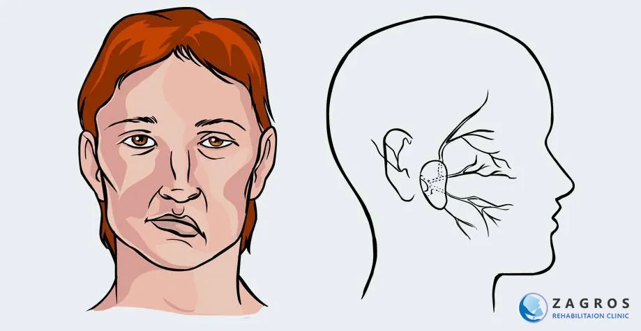 عوامل خطر غیرقابل اصلاح سکته مغزی ، پیشگیری از سکته مغزی، خطر وقوع سکته مغزی ، عوامل خطر سکته مغزی ، چه‌کار می‌توانید بکنید تا از سکته مغزی پیشگیری کنید؟